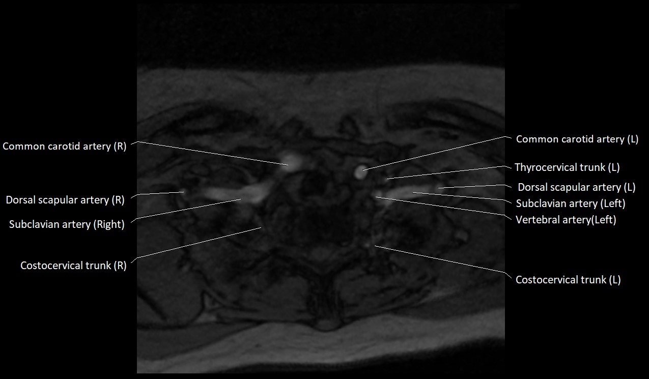 Carotid artery anatomy axial 3T image 68.jpg